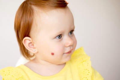 Ангиома у ребенка