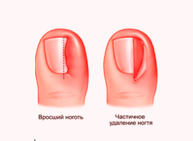 Резекция вросшего ногтя