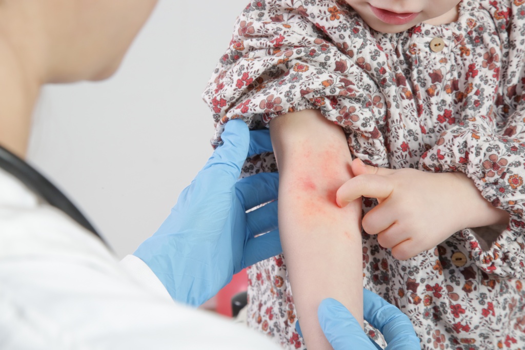 Прием детского врача-аллерголога