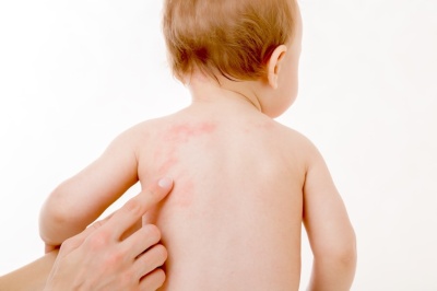 Потница у ребенка